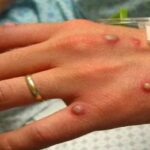 Monkeypox Symptoms: केरल में मंकीपॉक्स का एक और मामला मिला, जाने इसके लक्षण