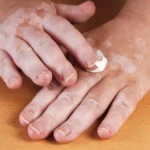 Health Care Tips: शरीर में दिखाई देने वाले इन लक्षणों को ना करें नजरअंदाज हो सकता है Vitiligo !