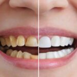 Beauty Care Tips: पीले दांतो की वजह से आपको भी होती है शर्मिंदगी तो अपनाएं यह घरेलू नुस्खे !