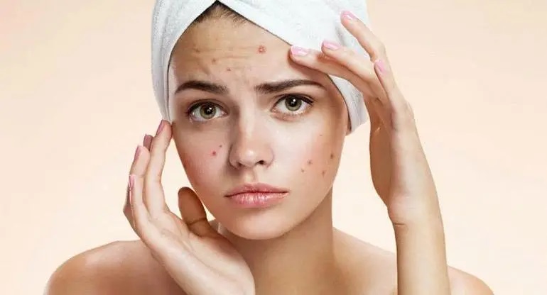 Skin Care Tips: मुहासे की समस्या से छुटकारा पाने के लिए इन होममेड फेस पैक का करें इस्तेमाल !
