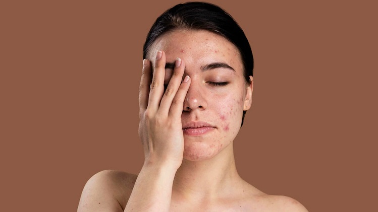 Skin Care Tips: डैमेज स्किन की समस्या से राहत पाने के लिए इस तरह करें एवोकाडो का इस्तेमाल !