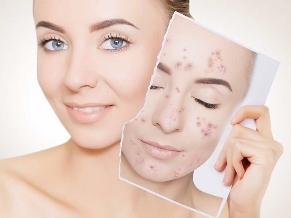 Skin Care Tips: त्वचा पर होने वाले कील मुहांसों को दूर करने के लिए इस्तेमाल करें ये होममेड फेक पैक !