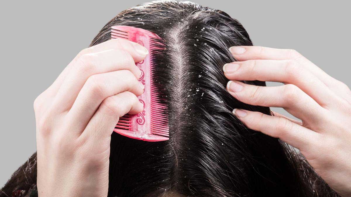 Hair Care Tips: ये घरेलू उपाय अपनाकर पाए डैंड्रफ की समस्या से छुटकारा, आइए जानें !