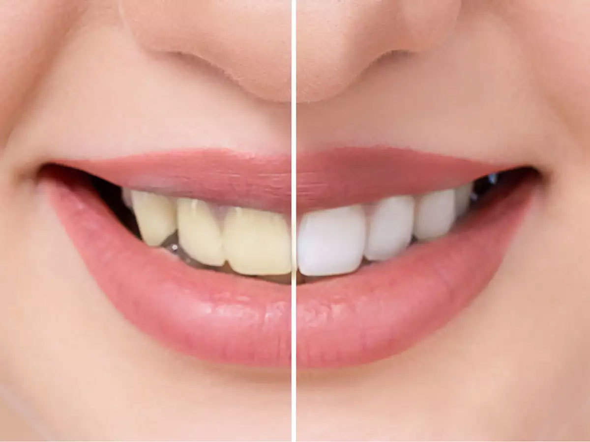 Beauty Care Tips: अपने दांतो का पीलापन दूर करने के लिए अपनाएं ये आसान तरीके !