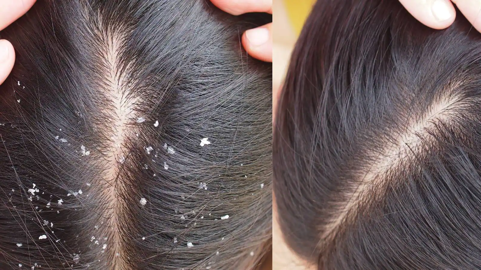Hair Care Tips: डैंड्रफ और गिरते बालों की समस्या से राहत पाने के लिए इस होममेड शैंपू का करें इस्तेमाल !