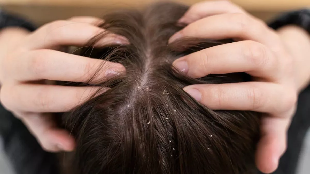 Hair Care Tips: बढ़ जाती है सर्दियों में डैंड्रफ की समस्या, राहत पाने के लिए एप्पल साइडर विनेगर का करें इस्तेमाल !
