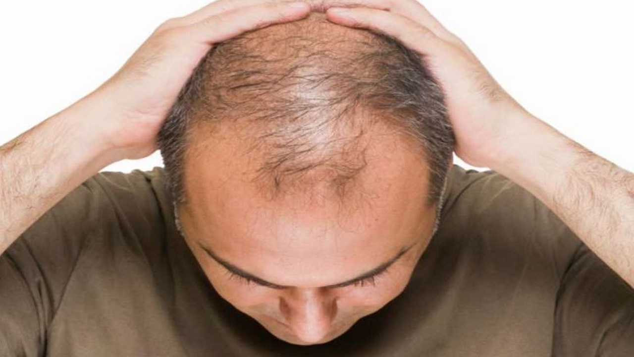 Hair Care Tips: गंजेपन की समस्या से बचे रहने के लिए भूलकर भी ना करें इस चीज का सेवन !