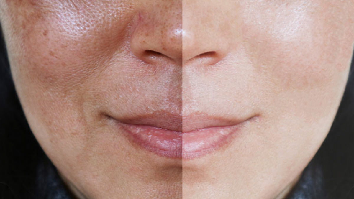 Skin Care Tips: चेहरे पर होने वाली झाइयों की समस्या से राहत पाने के लिए इस तेल का करें इस्तेमाल !