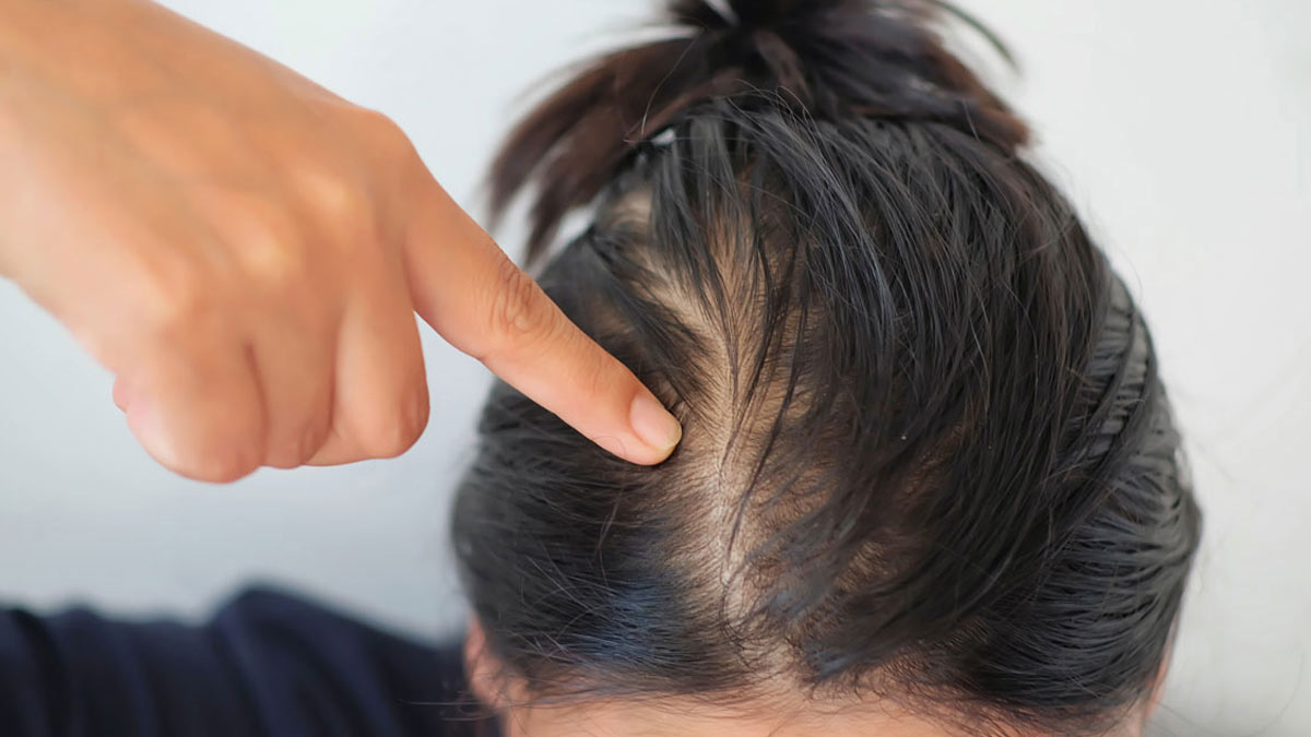 Hair Care Tips : हेयर फॉल की समस्या से राहत पाने के लिए अपनाएं ये घरेलू नुस्खे, जल्द मिलेगी राहत !