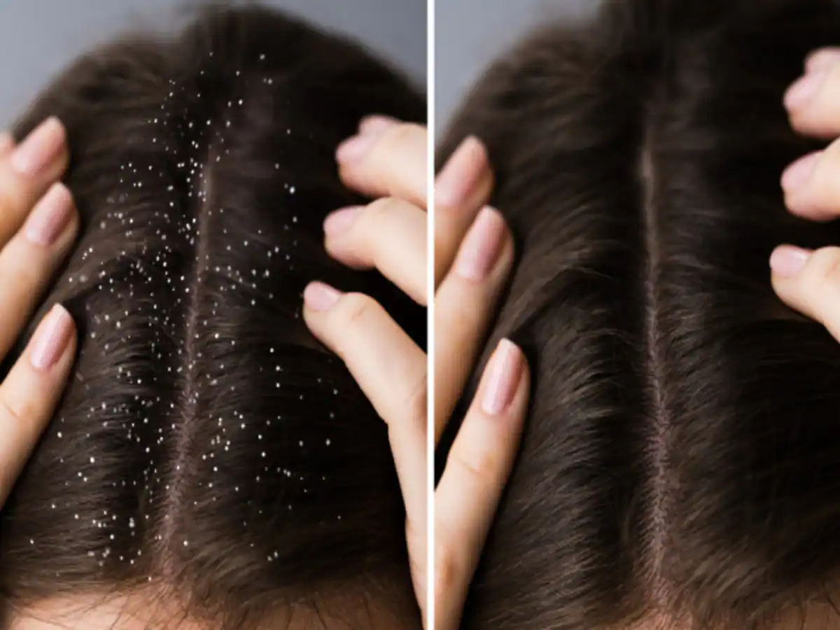 Hair Care Tips: बालों में होने वाले डैंड्रफ की समस्या से राहत पाने के लिए अपनाए ये कारगर उपाय !