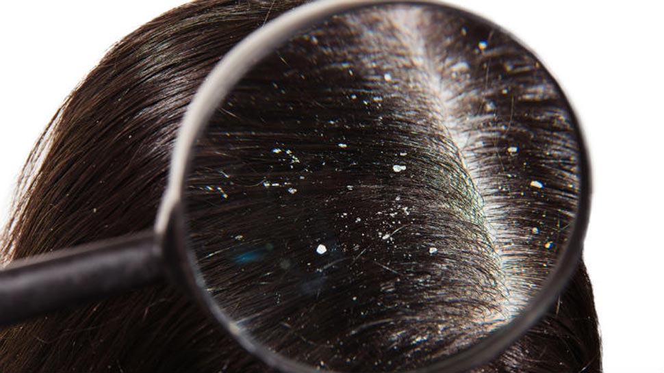 Hair Care Tips: डैंड्रफ की समस्या से राहत पाने के लिए इन 2 चीजों के इस्तेमाल से तैयार करें एंटी डैंड्रफ ऑयल !