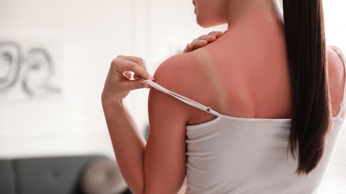 Skin Care Tips: सनबर्न की समस्या से राहत पाने के लिए एलोवेरा का इस तरह करें इस्तेमाल !