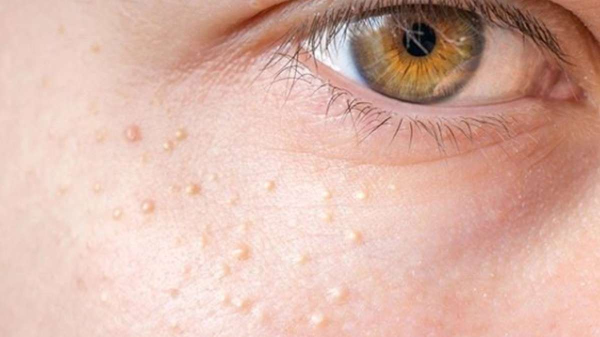 Skin Care Tips: मेकअप के इस्तेमाल से चेहरे पर होने वाले दानों की समस्या से राहत के लिए अपनाएं ये नुस्खा !