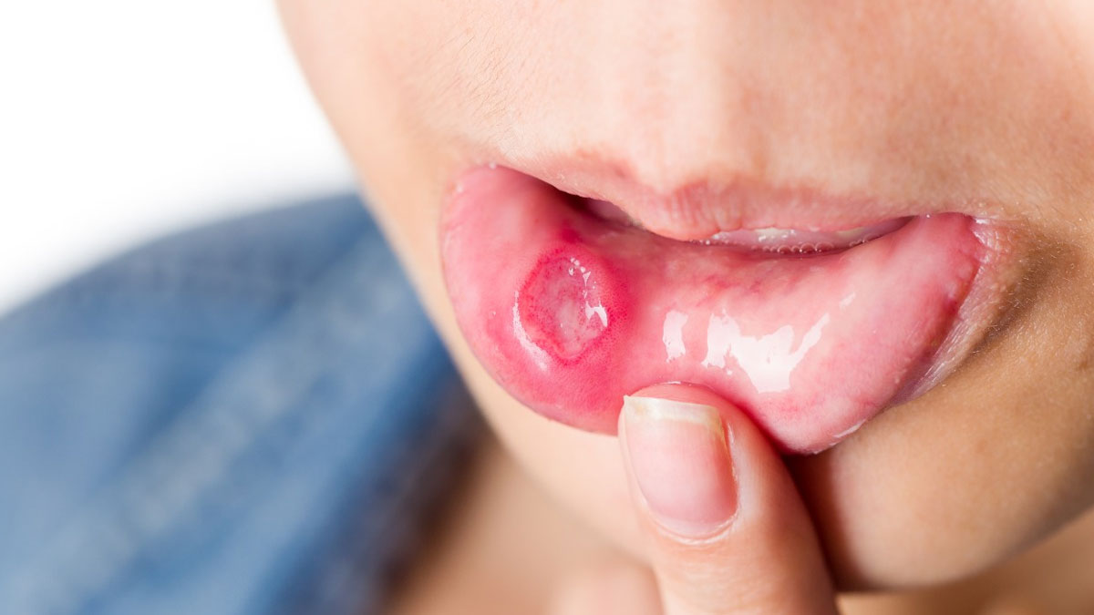 Health Care Tips: मुंह में दिखाई दे यह लक्षण तो ना करें नजरअंदाज हो सकती है कैंसर की समस्या !