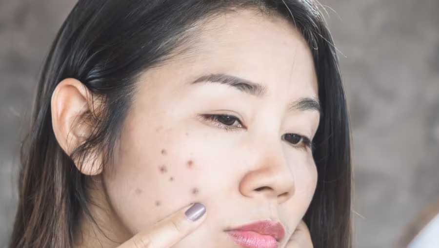 Skin Care Tips: चेहरे पर होने वाले डार्क स्पॉट्स और एक्ने की समस्या को दूर करने के लिए करें कोकोनट ऑयल का इस्तेमाल !