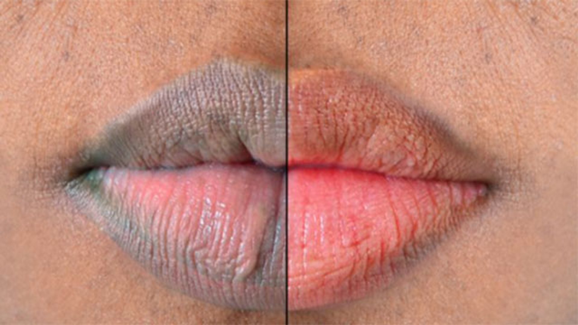 Beauty Tips: बेसन का इस तरह इस्तेमाल, होठों का कालापन होगा दूर !