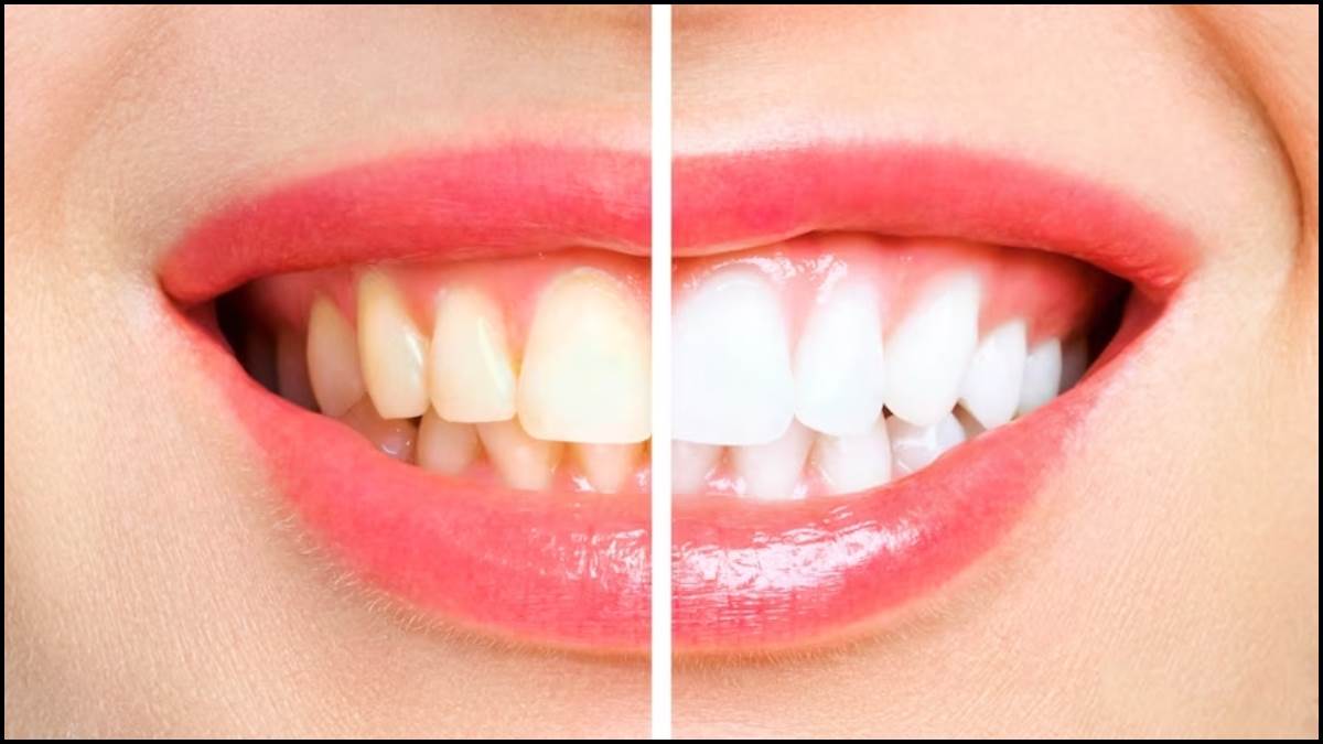 Teeth Cleaning Tips: दातों की चमक बनाए रखने के लिए नहीं करनी पड़ेगी ज्यादा मेहनत, इन टिप्स को करें फोलो !