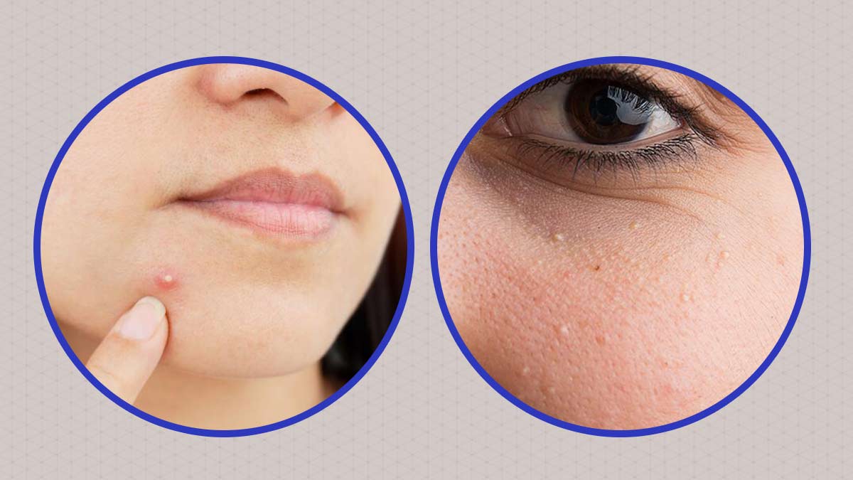 Skin Care Tips: चेहरे पर होने वाले व्हाइटहेड्स की समस्या से राहत पाने के लिए अपनाए ये घरेलू नुस्खे !