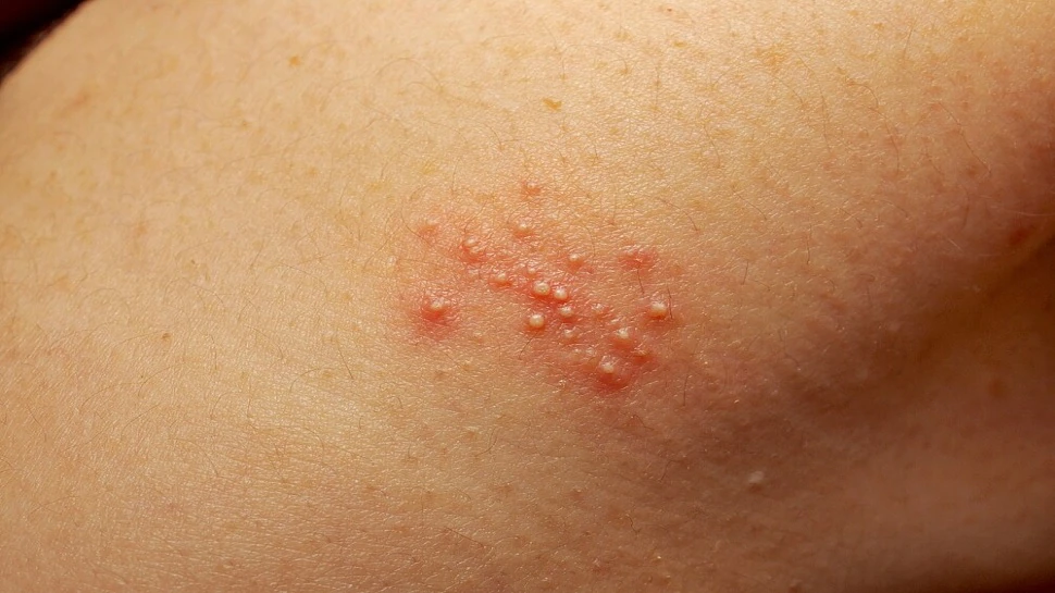 Skin Care Tips: गर्मियों में त्वचा पर होने वाली घमौरियों की समस्या से राहत पाने के लिए अपनाएं ये घरेलू नुस्खे !