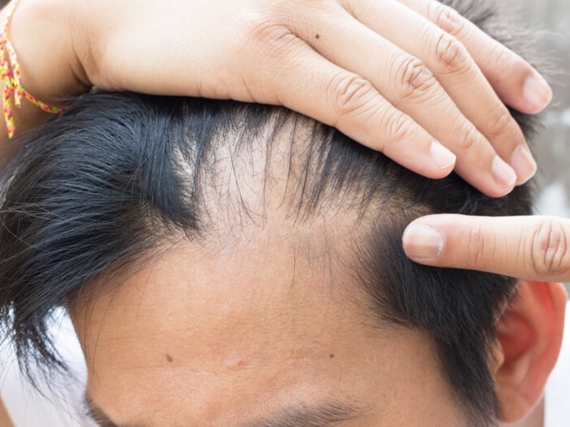 Hair Care Tips: बहुत ज्यादा मात्रा में झड़ने लगे हैं आपके बाल, राहत के लिए इस होममेड हेयर सीरम का करें इस्तेमाल !
