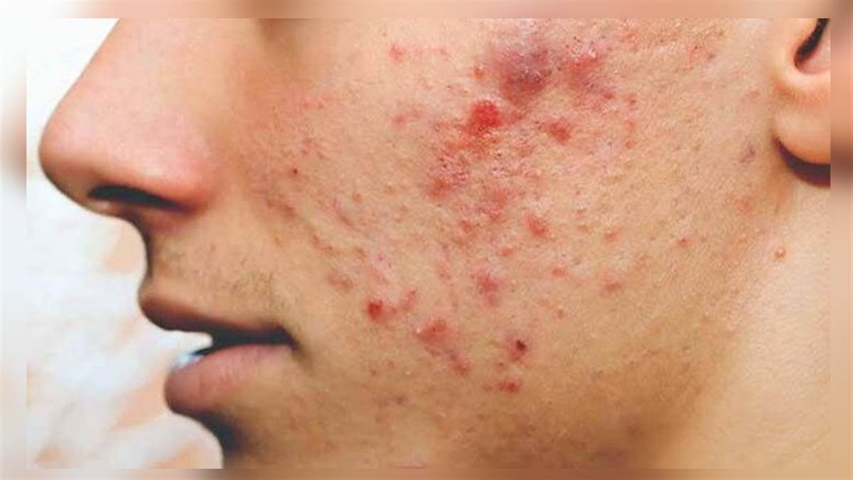 Skin Care Tips: पिंपल्स की समस्या से राहत पाने के लिए चेहरे पर इस तरह करें फिटकरी का इस्तेमाल !