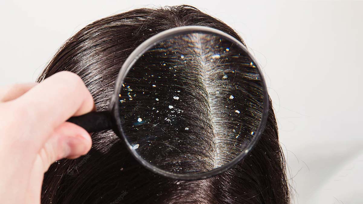 Hair Care Tips: मानसून में होने वाली डैंड्रफ की समस्या से राहत पाने के लिए सरसों के तेल का इस तरह करें इस्तेमाल !