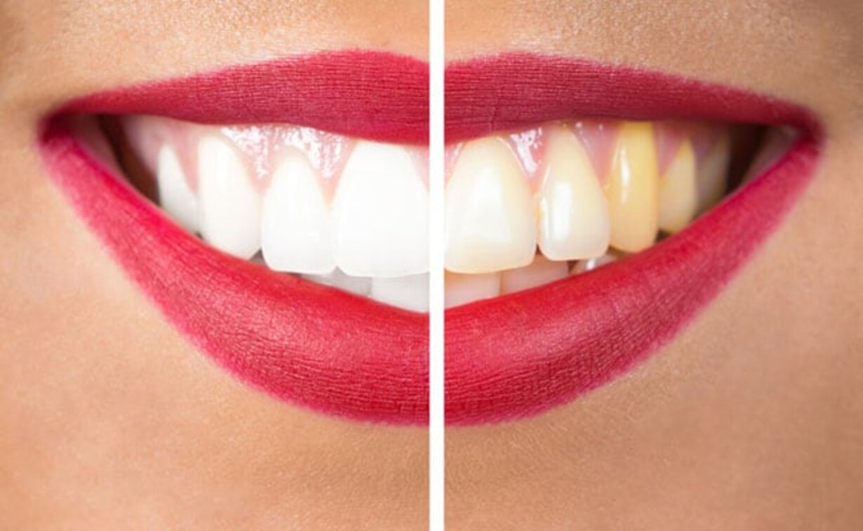 Beauty Tips: दांतो के पीलेपन की वजह से आपको भी होना पड़ता है शर्मिंदा, राहत के लिए अपनाएं ये आसान उपाय !
