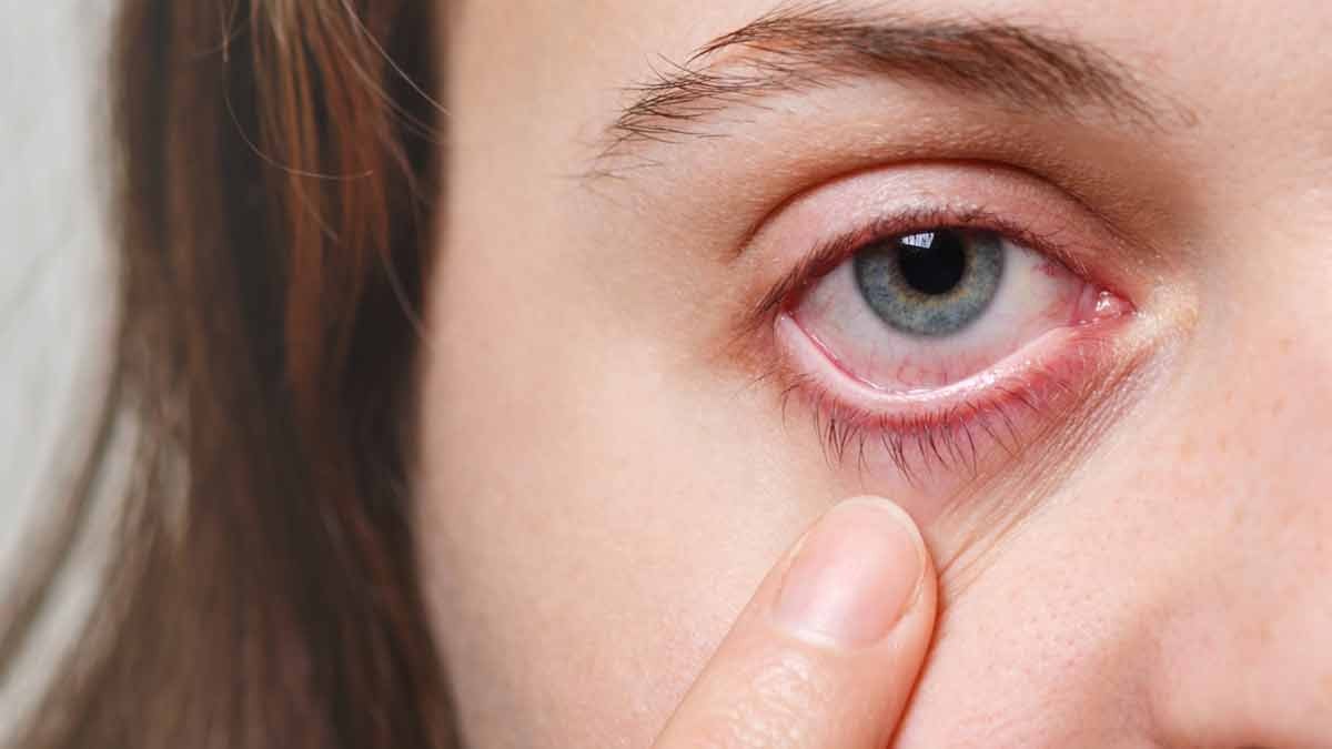 Eye Health Tips: आंखों में होने वाली जलन की समस्या से है परेशान, तो राहत के लिए अपनाएं ये आसान उपाय !