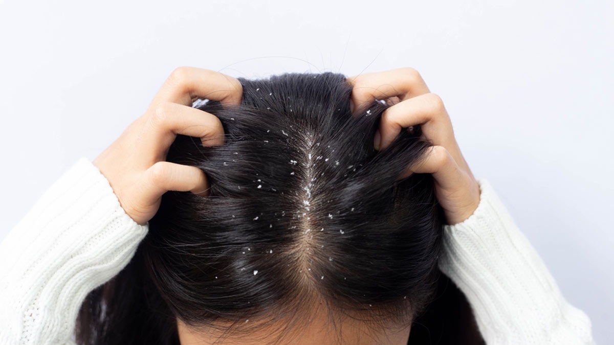 Hair Care Tips: बालों में होने वाले डेंड्रफ की वजह से हो चुके हैं परेशान तो तुरंत राहत के लिए अपनाएं ये घरेलू नुस्खे !