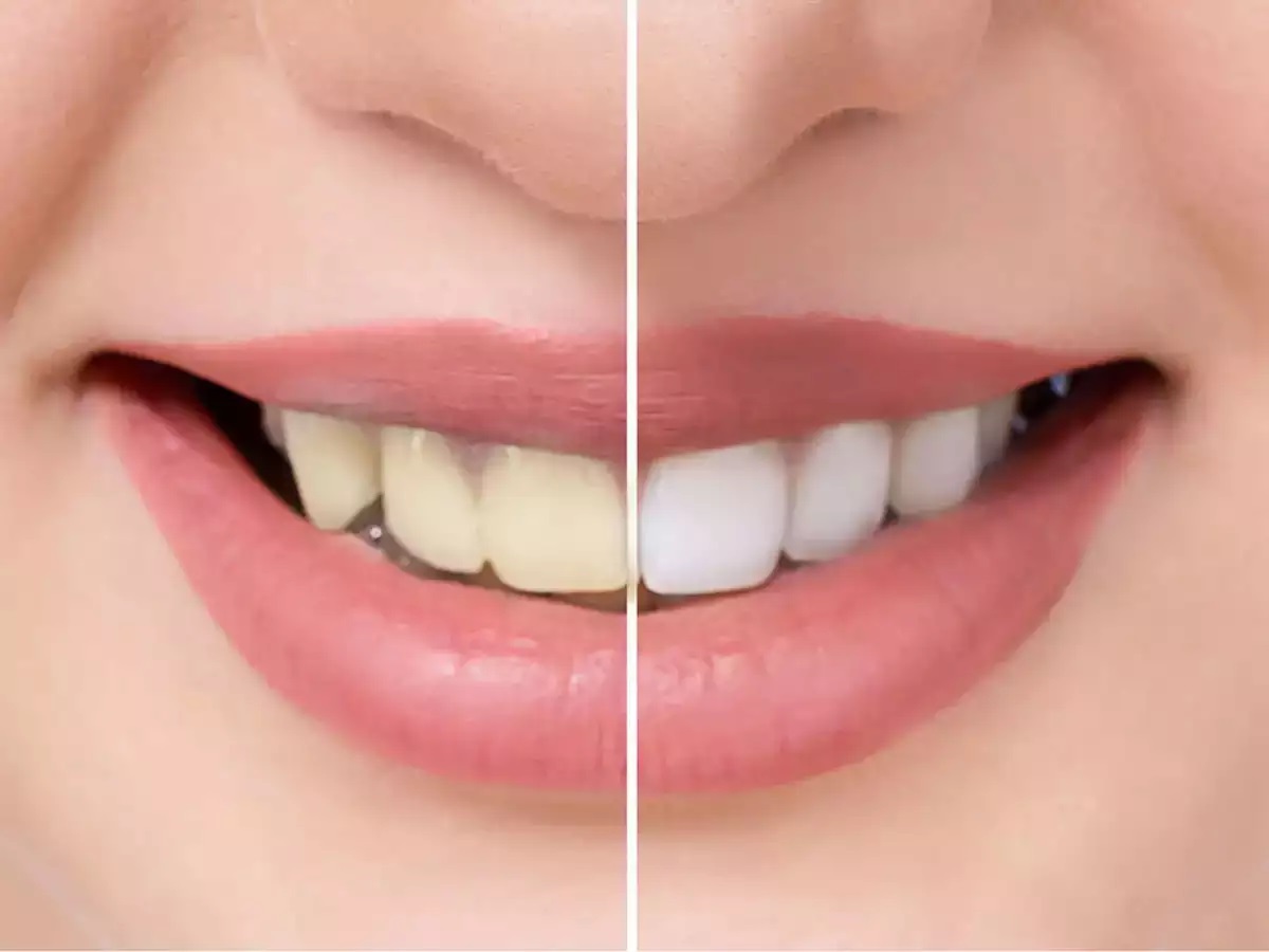 Oral Health Tips: दांतों के पीलेपन की वजह से होना पड़ता है शर्मिंदा, तो दांतो की सफेदी के लिए अपनाएं ये खास उपाय !